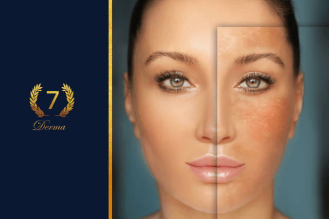 Learn about home remedies for hyperpigmentation for face