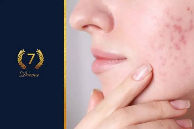 acne scar treatment in dubai - cover
